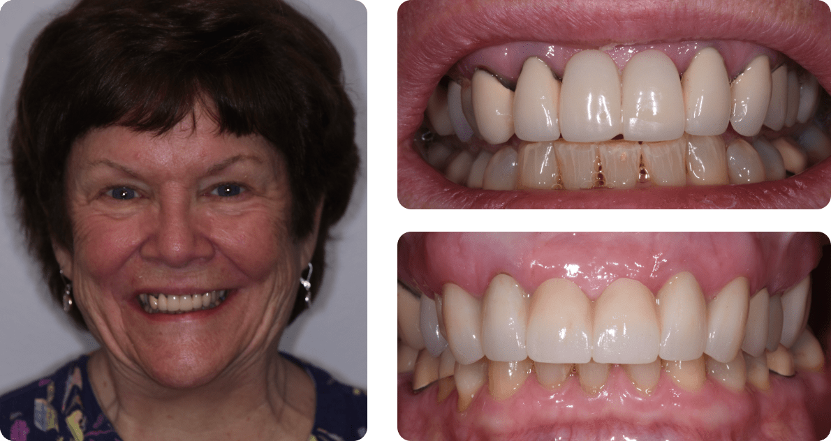 A collage of a patient's photo and photos of her teeth before and after a 6 unit bridge
