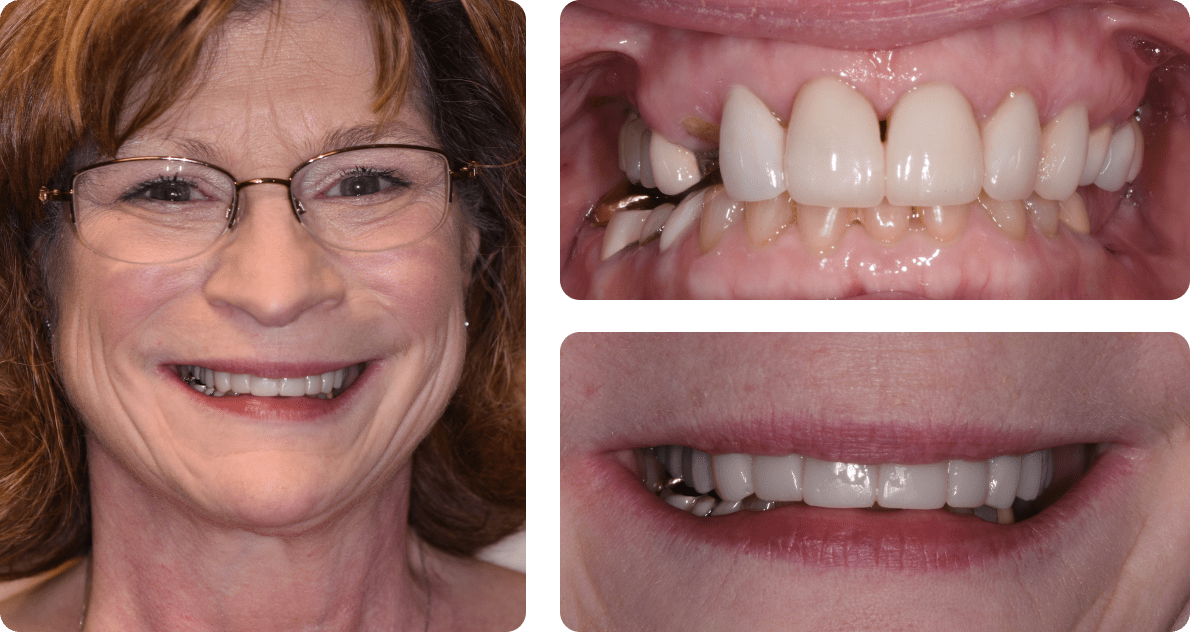 A collage of a patient's photo and photos of her teeth before and after the treatment