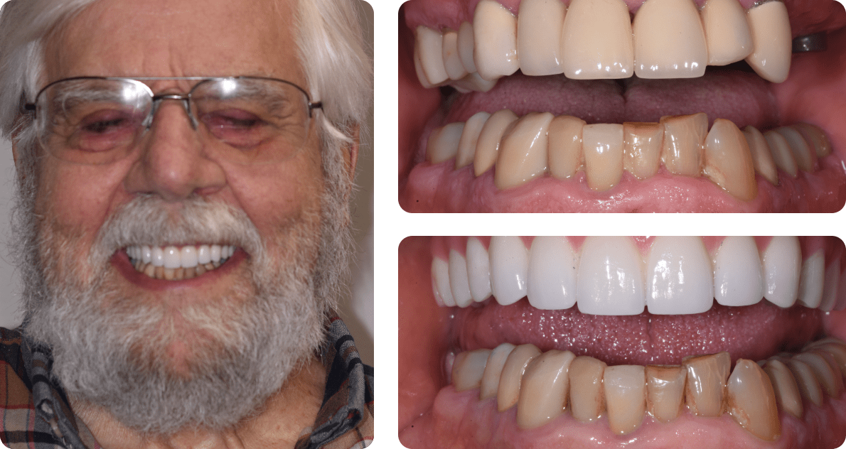 A collage of a patient's photo and photos of his teeth before and after treatment