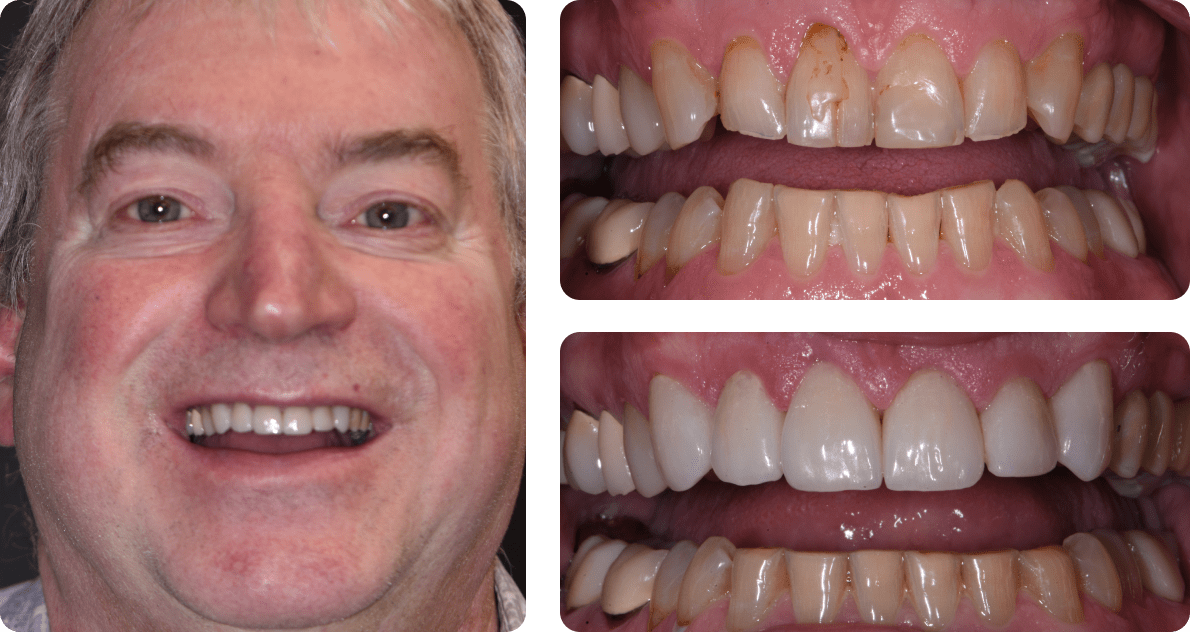 A collage of a patient's photo & photos of his teeth before and after the treatment
