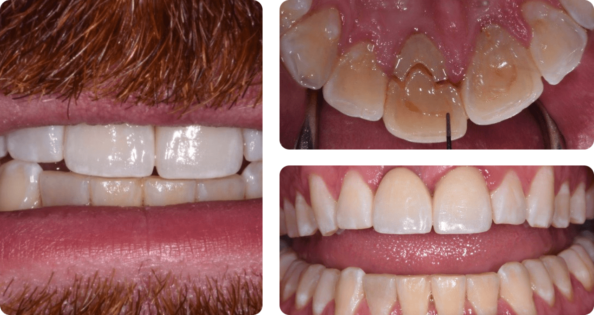 A collage of a patient's teeth before and after the treatment