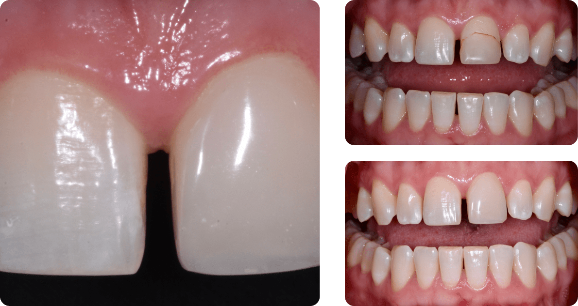 A collage of patient's teeth before and after the treatment