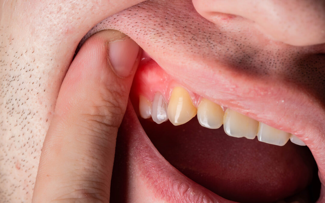 Unhealthy Gums: Your Guide to Maintaining A Better Smile